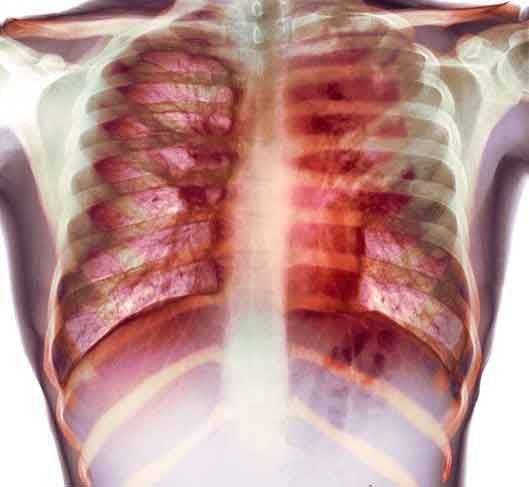 Pordenone: incontro all'Operaia sulla tubercolosi